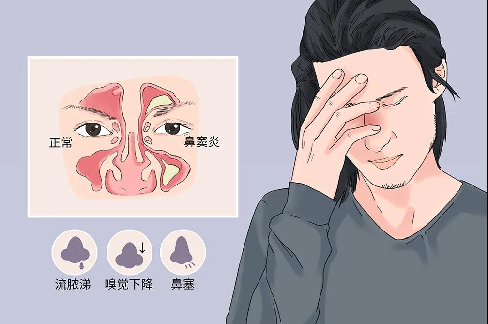鼻塞鼻出血,嗅觉障碍…成都民生耳鼻喉提醒:你可能得了鼻窦炎!